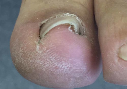 Expert Tips for Dealing with Thick Toenails: From a Podiatrist's Perspective