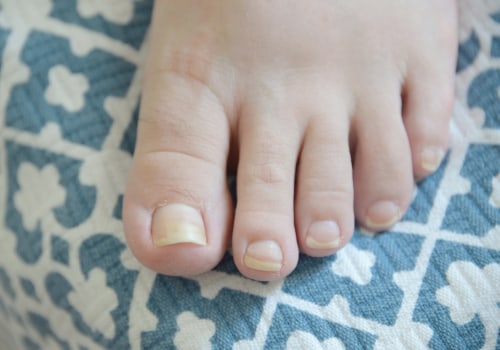 Thick Toenails: Understanding the Causes, Symptoms, and Treatment