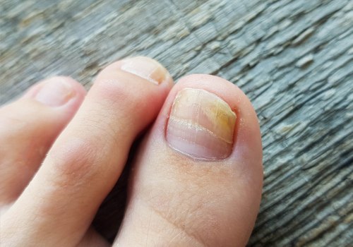 Expert Tips for Treating Toenail Fungus