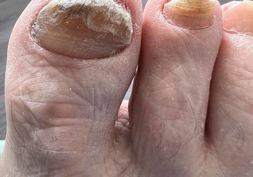 Expert Tips for Healthy Toenails