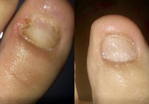 The Truth About Hydrogen Peroxide and Toenail Fungus: An Expert's Perspective