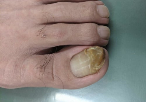 The Best Doctor for Treating Toenail Fungus