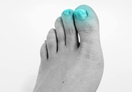 Expert Tips for Managing Thickened Toenails