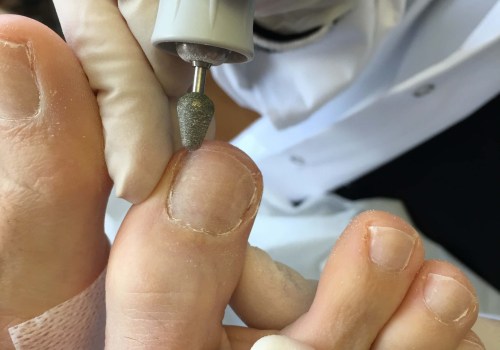 The Most Effective Treatment for Toenail Fungus: A Dermatologist's Perspective