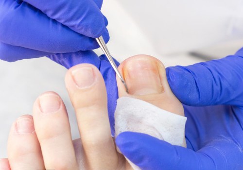 The Importance of Seeking Professional Help for Toenail Care